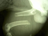 Zlomenina stehenn� kosti a jej� chirurgick� �e�en�